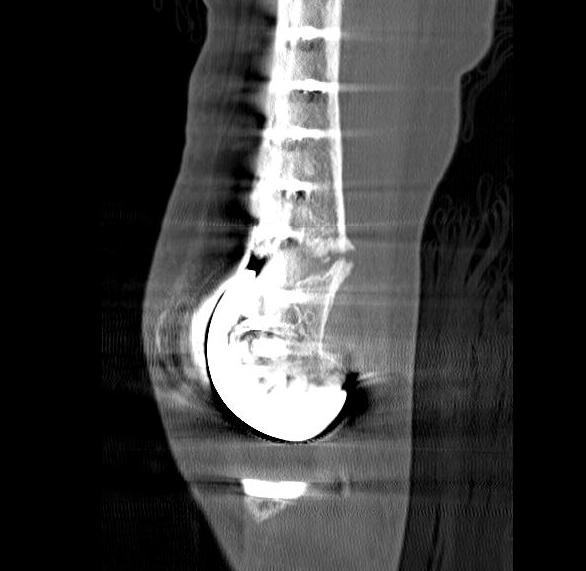 Periprosthetic TKR Locking Plate Nonunion 30002